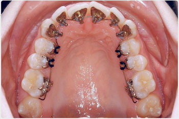 aparat dentar incognito
